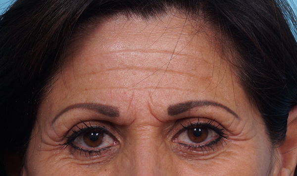 Brow Lift