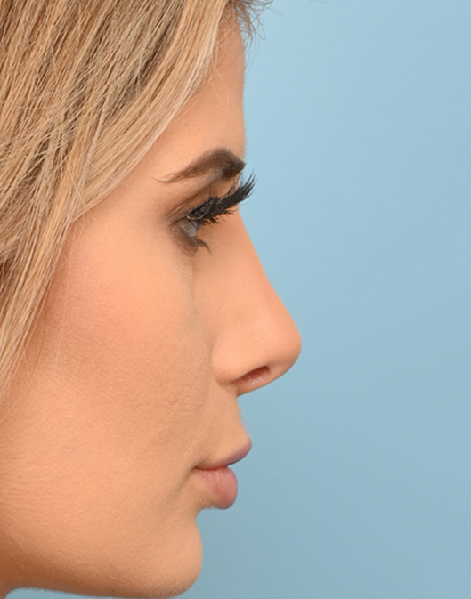 Rhinoplasty