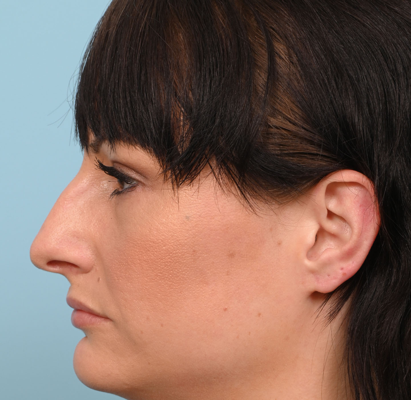 Rhinoplasty