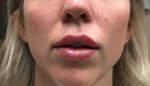 Lip Augmentation/Injectables