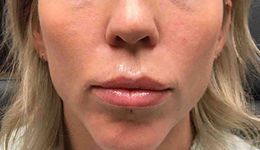 Lip Augmentation/Injectables