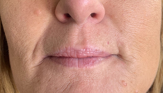 Lip Augmentation/Injectables