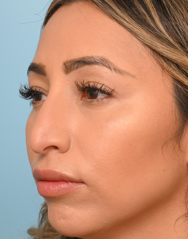 Rhinoplasty