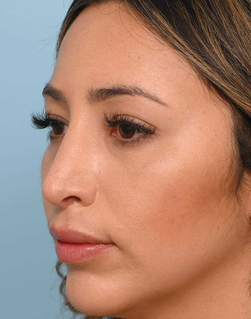 Rhinoplasty