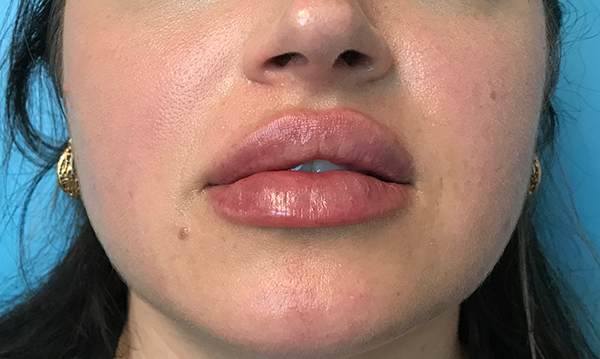 Lip Augmentation/Injectables