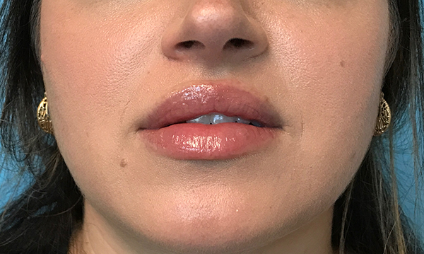 Lip Augmentation/Injectables