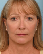 Facial Fat Transfer
