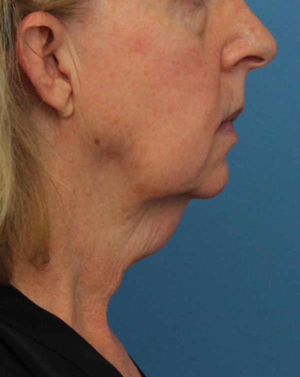 Facial Fat Transfer