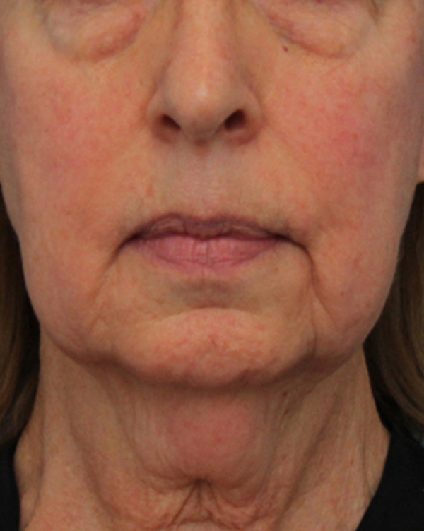 Facial Fat Transfer