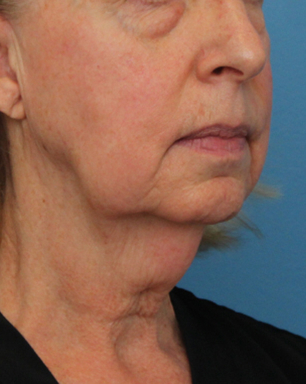 Facial Fat Transfer