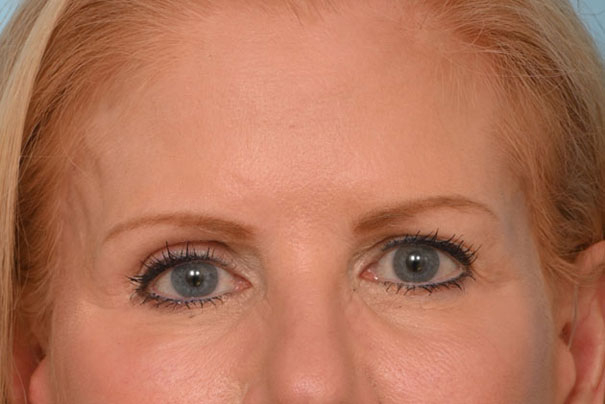 Brow Lift