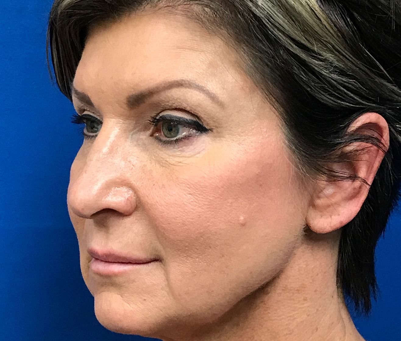 Rhinoplasty