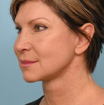 Face Lift/Neck Lift