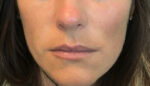 Lip Augmentation/Injectables