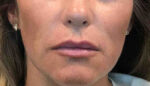 Lip Augmentation/Injectables