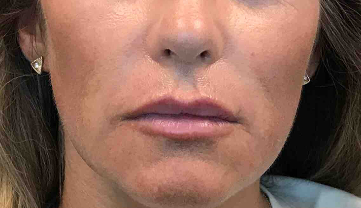 Lip Augmentation/Injectables