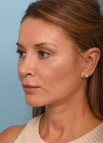 Rhinoplasty