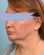 Face Lift/Neck Lift