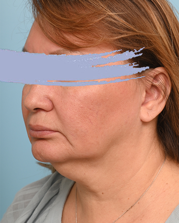 Face Lift/Neck Lift