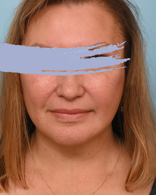 Face Lift/Neck Lift