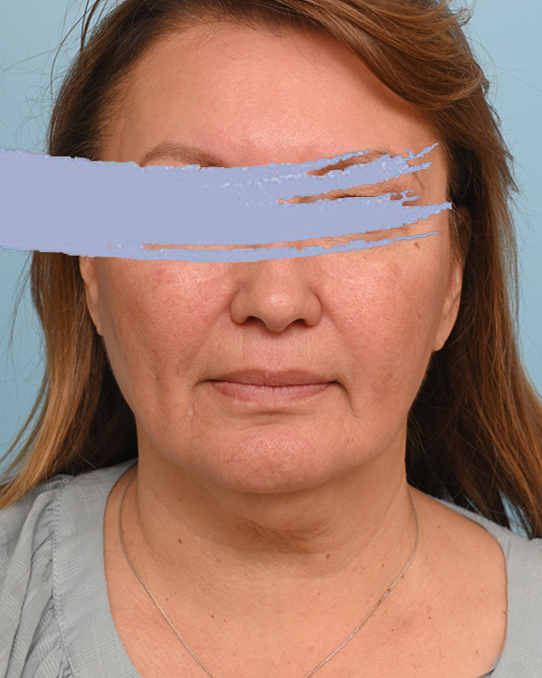 Face Lift/Neck Lift