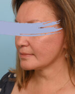 Face Lift/Neck Lift