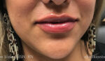 Lip Augmentation/Injectables