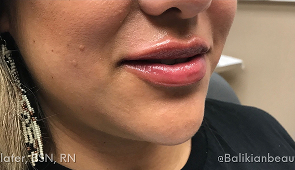 Lip Augmentation/Injectables