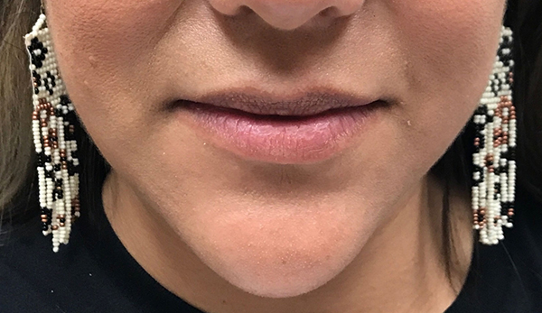 Lip Augmentation/Injectables