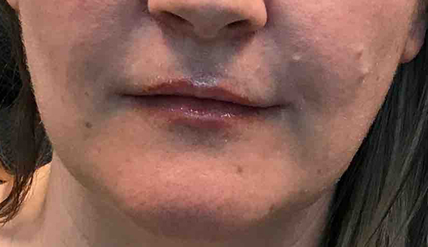 Lip Augmentation/Injectables