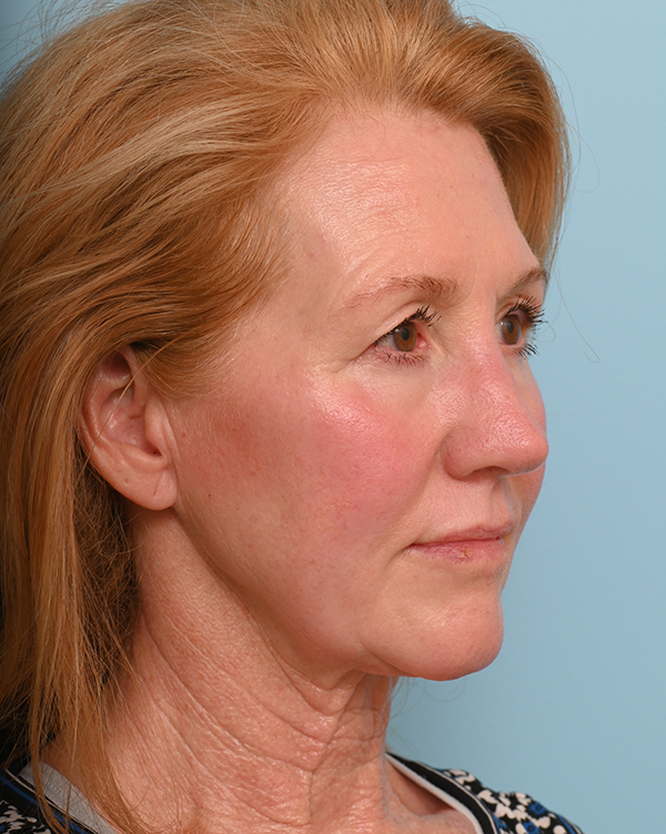 Facial Fat Transfer