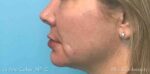 Lip Augmentation/Injectables