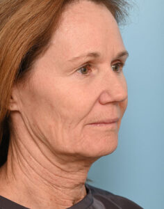 Patient 16557 16557 55149