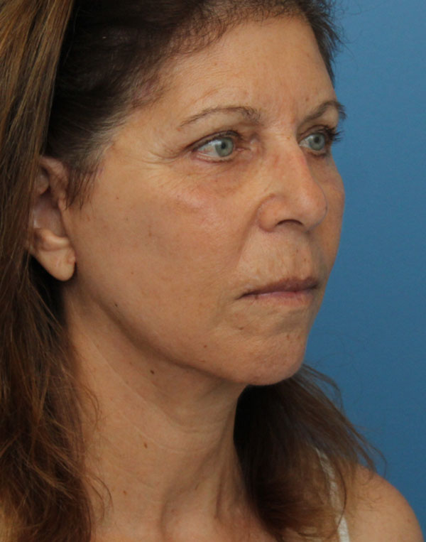 Face Lift/Neck Lift