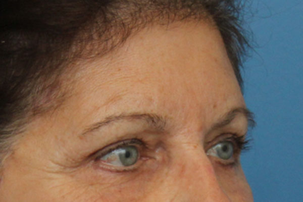 Brow Lift