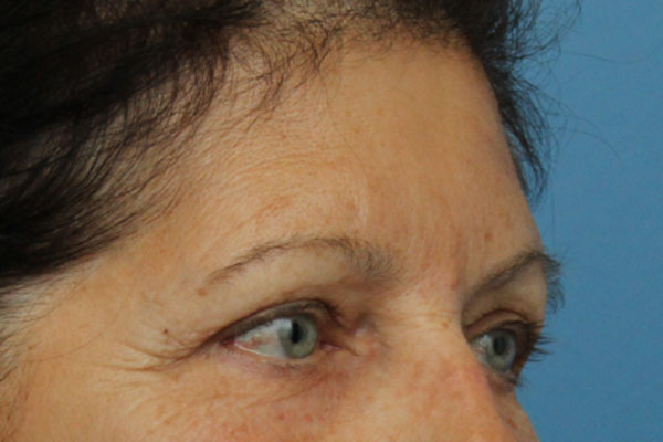 Brow Lift