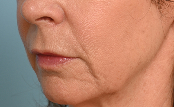 Lip Lift