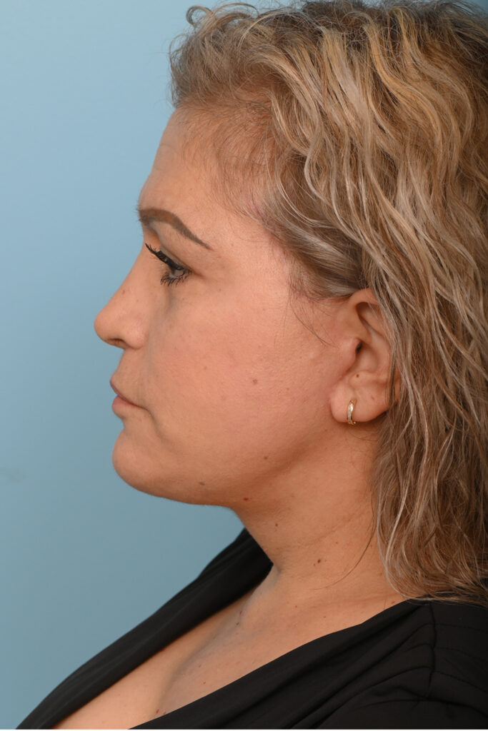 Face Lift/ Mini Lift/ Neck Lift