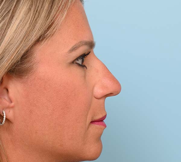 Rhinoplasty