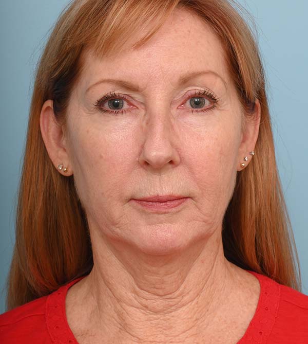 Face Lift/ Mini Lift/ Neck Lift