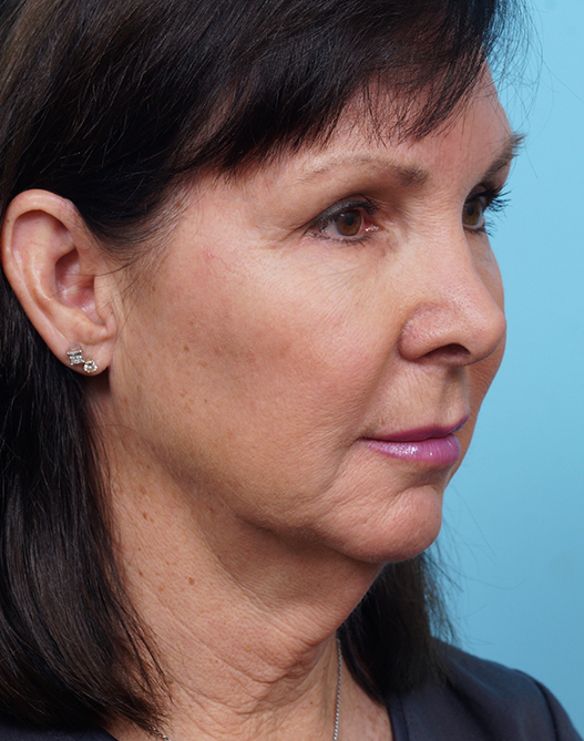 Face Lift/Neck Lift