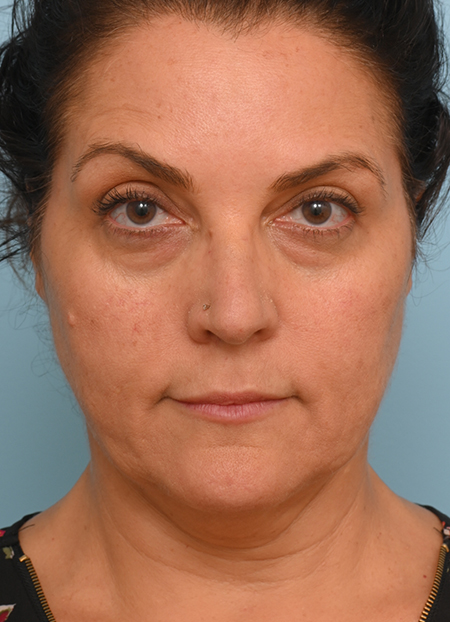 Face Lift/ Mini Lift/ Neck Lift