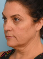 Face Lift/ Mini Lift/ Neck Lift