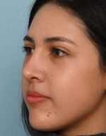 Rhinoplasty