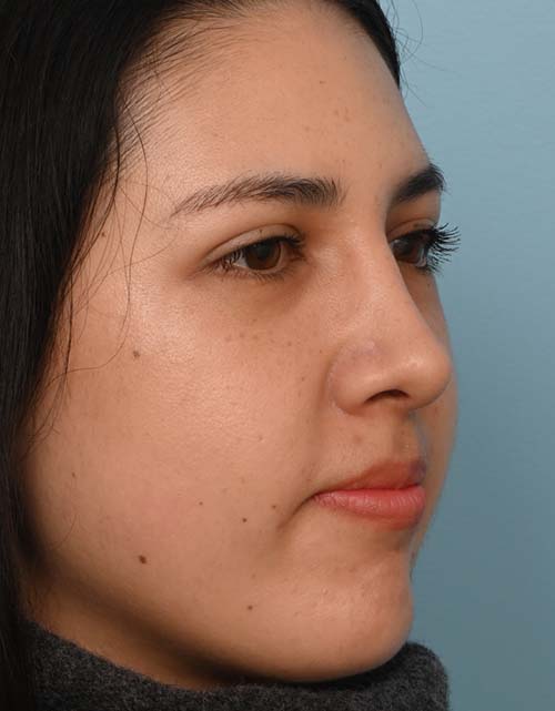 Rhinoplasty