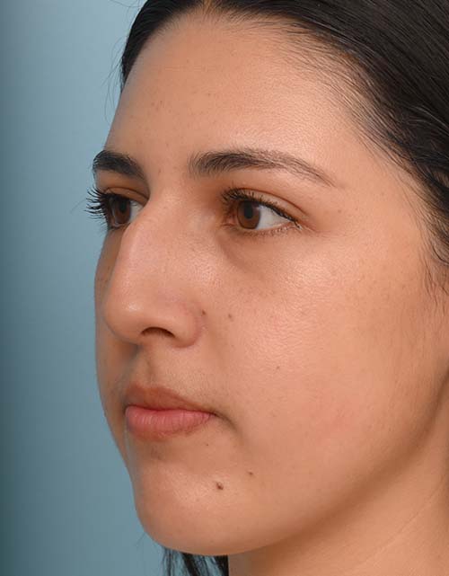 Rhinoplasty