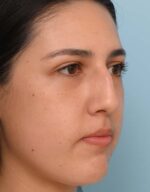 Rhinoplasty