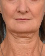 Face Lift/Neck Lift