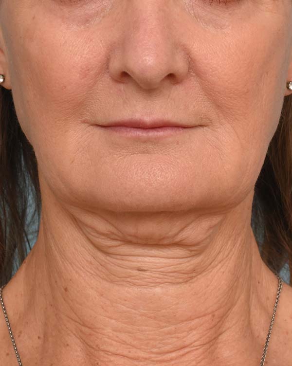 Facial Fat Transfer