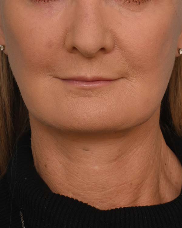 Facial Fat Transfer